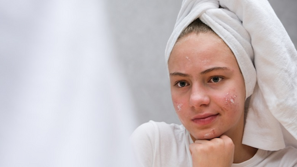 Best Facial for Acne-Prone Skin