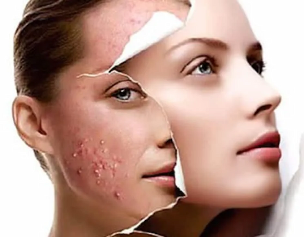 Best Facial for Acne-Prone Skin